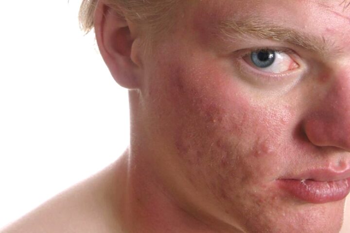 ニキビ肌の方に朗報⁉「ニキビがあると将来肌は老化しにくい」は本当か？？