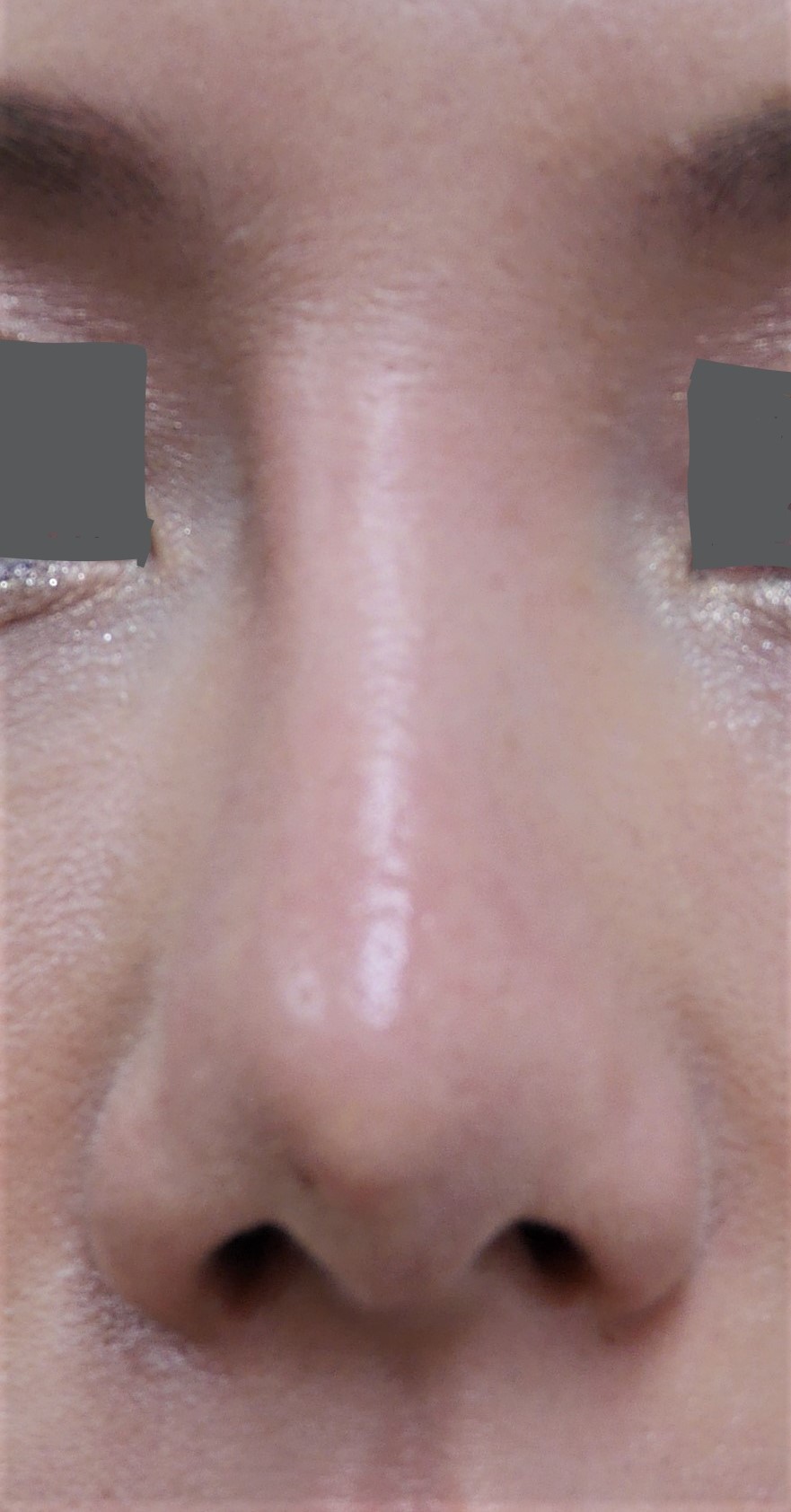 鼻プロテーゼのトラブル解決には自己組織の移植による修正が理想である理由 Dr 松下ブログ 五本木クリニック