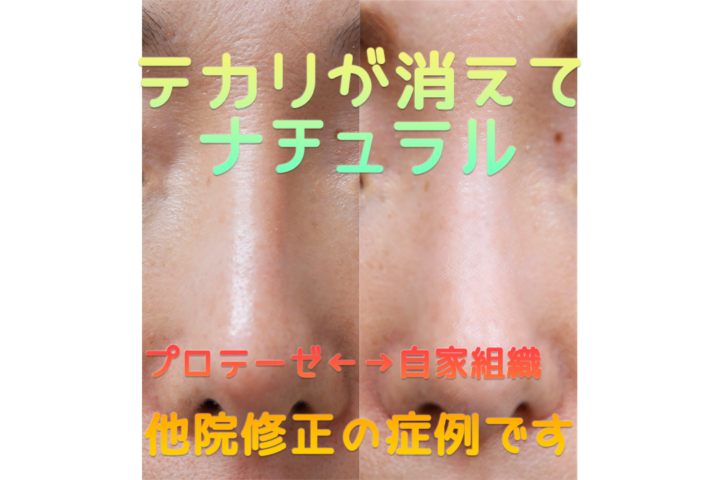 鼻のプロテーゼを自己組織に入れ替えた後の詳しい経過写真