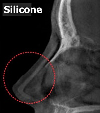 鼻のレントゲンに映ってしまうプロテーゼ
