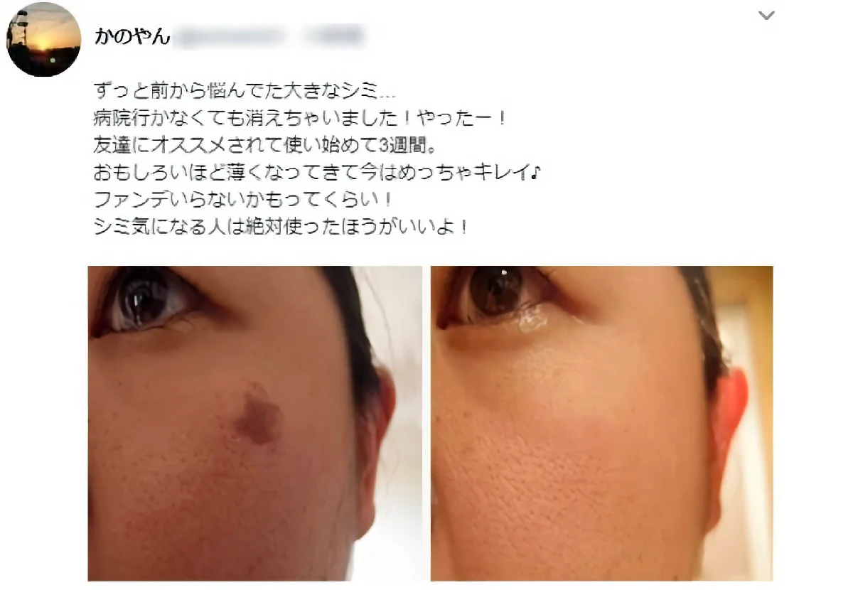 美白化粧品でシミは消えるの?本当にシミが消えるなら医薬品に昇格です