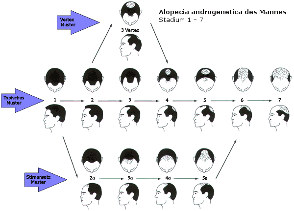 脱毛の部位や重症度の分類