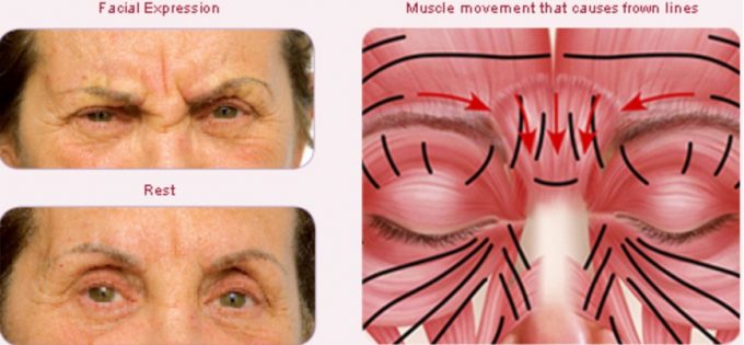 ボトックスで眉間のシワを消そうと考えている方へ 院長ブログ 五本木クリニック