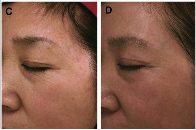 PRP＆フラクショナルレーザー治療を受けた57歳女性の顔の変化