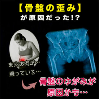 何でもかんでも骨盤の歪みのせいにする安易な広告