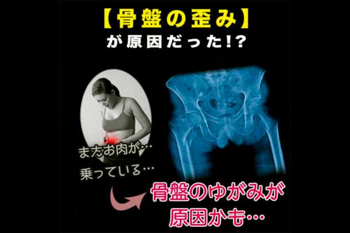 【ネット広告の闇】ダイエットする前に骨折の治療を優先しようよ❗