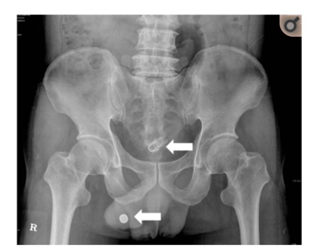 Unusual foreign bodies in the urinary bladder and urethra due to autoerotism