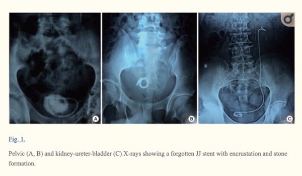 Foreign Bodies in the Urinary Bladder and Their Management: A Single-Centre Experience From North India