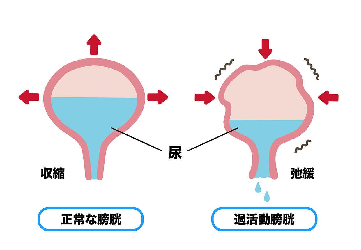 正常な膀胱と過活動膀胱との比較イラスト