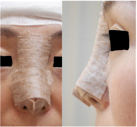 鼻のプロテーゼを自己組織に入れ替えた後の詳しい経過写真