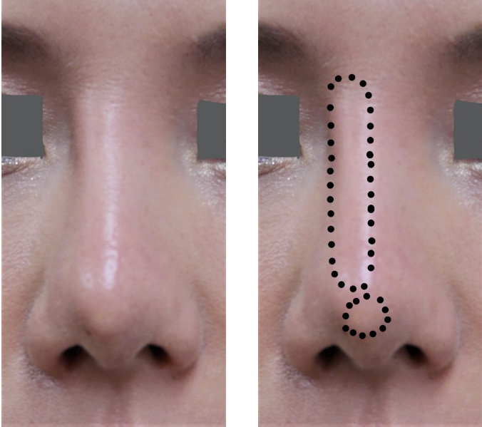 鼻プロテーゼのトラブル解決には自己組織の移植による修正が理想である理由