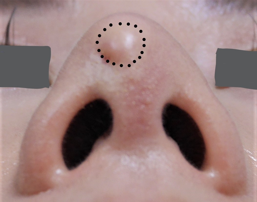 鼻プロテーゼの輪郭が浮き出てしまった症例