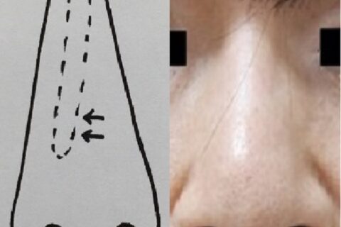 【30年の悩みがスッキリ解消】鼻のプロテーゼを抜去して自己組織へ入れ替え