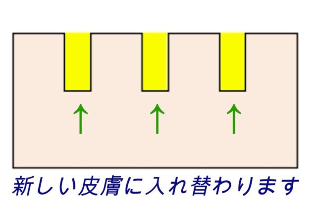 ニキビ跡にお悩みの方へ、フラクショナルレーザーって知っていますか？