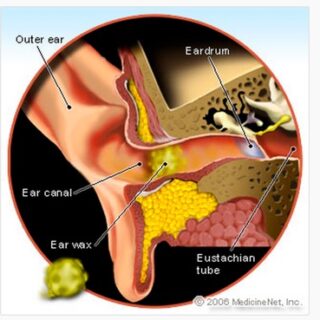 Ear_Wax__Click_for_Pictures_and_Home_Remedies