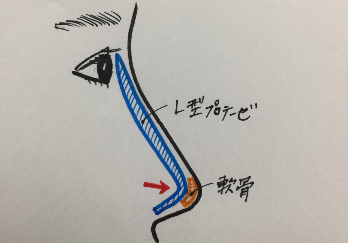 鼻プロテーゼが原因のトラブルなのに、プロテーゼを抜かずに自己組織移植を行った失敗例