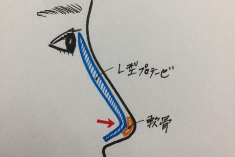 プロテーゼを抜かずに自家組織移植を行った結果、失敗だったという事例