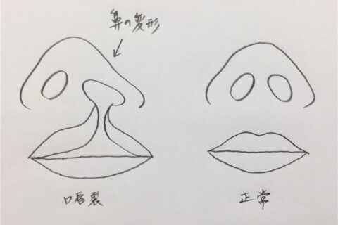 鼻プロテーゼを抜いたところに自己組織を移植する手術は、先天奇形を治す形成外科技術の応用