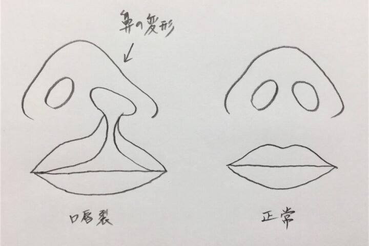 鼻プロテーゼを抜いたところに自己組織を移植する手術は、先天奇形を治す形成外科技術の応用