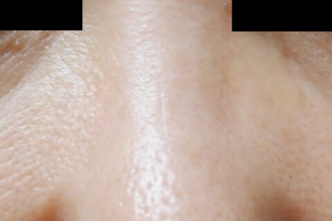 長年鼻にプロテーゼを入れていた方は、抜くだけで元の鼻に戻るわけではありません!