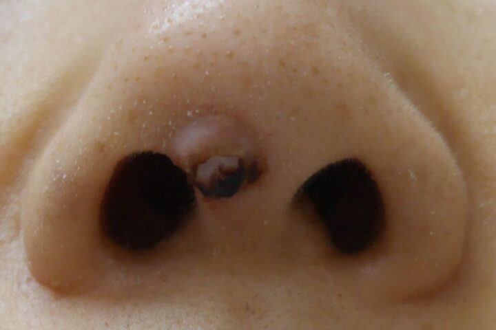 鼻に入れたプロテーゼが原因で皮膚に穴があいた症例