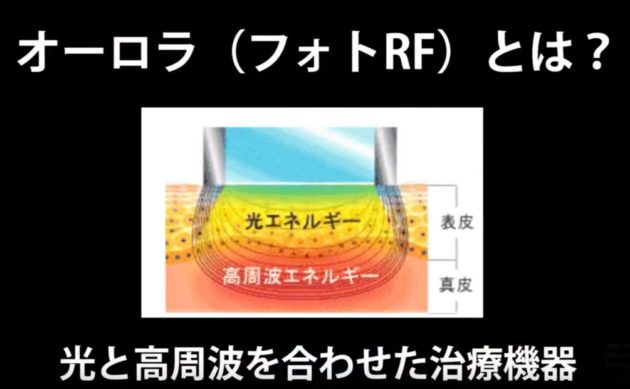 フォトRF（オーロラ）は美容皮膚科の基礎化粧品的治療方法だよ❗