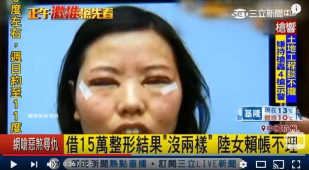 アジア圏で一番人気の美容整形は一重瞼を二重にする手術です