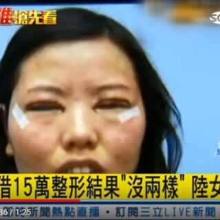 アジア圏で一番人気の美容整形は一重瞼を二重にする手術です