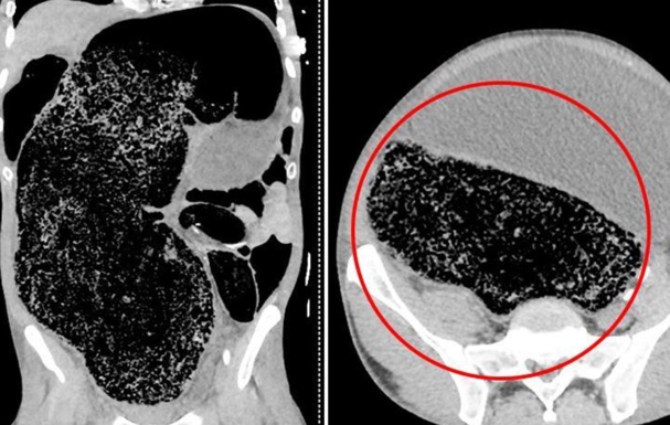 2キロの便秘が原因で下半身麻痺⁉ヘタすりゃ多臓器不全で死の可能性も。