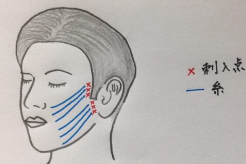 VOV リフト、糸を入れて顔のたるみをしっかりあげる新しい治療方法