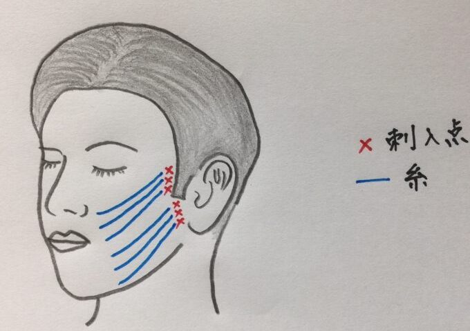 VOV リフト、糸を入れて顔のたるみをしっかりあげる新しい治療方法