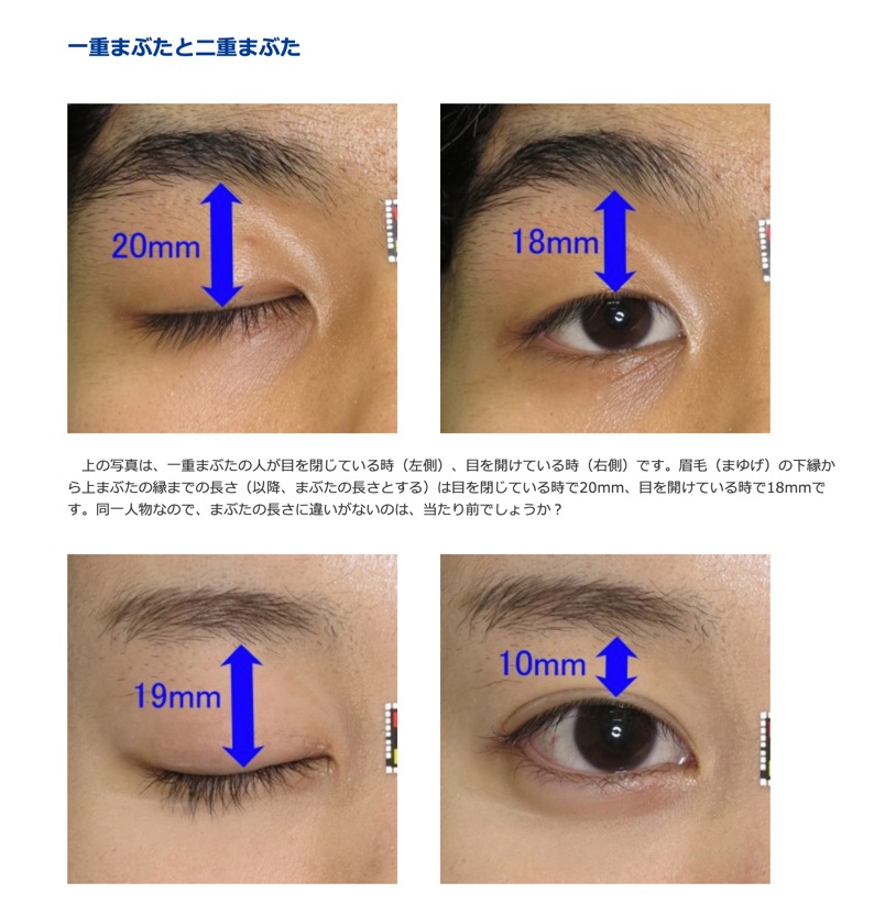 なぜ 一重まぶたの人は二重まぶたに憧れ 二重まぶたメイクや手術ををするのか 院長ブログ 五本木クリニック