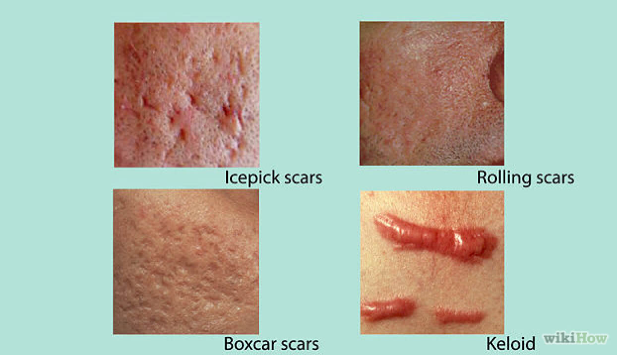 にきび跡（Acne Scar）の種類