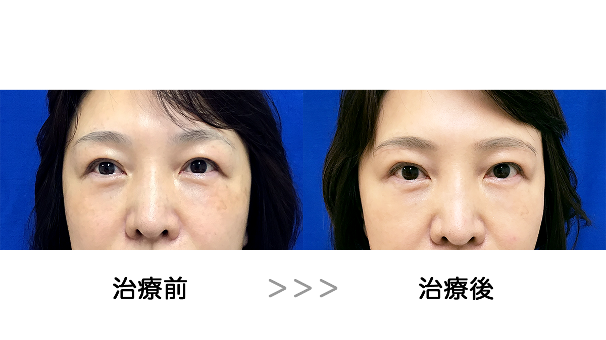 眉下切開による治療前後の比較写真