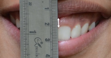 笑うと歯茎が４mm〜５mm出てしまうインドの女性患者さんの写真