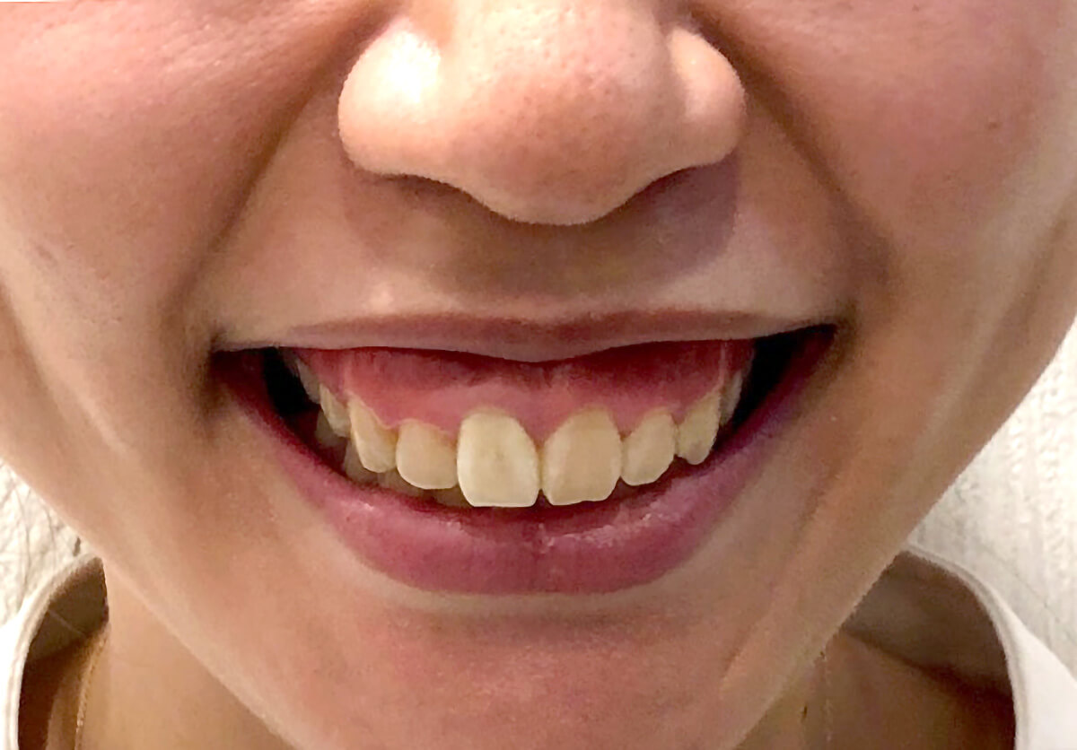 ガミースマイル治療前の正面から見た口元の写真