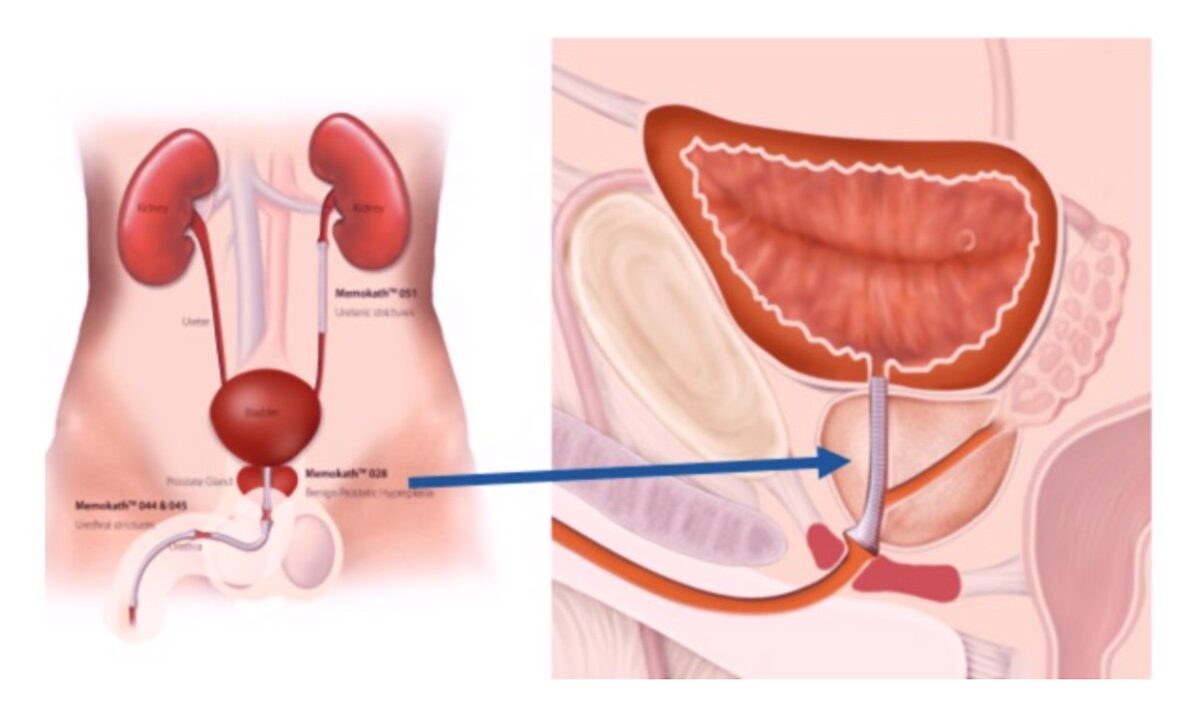 メモカスを使った前立腺肥大症の治療の解説図