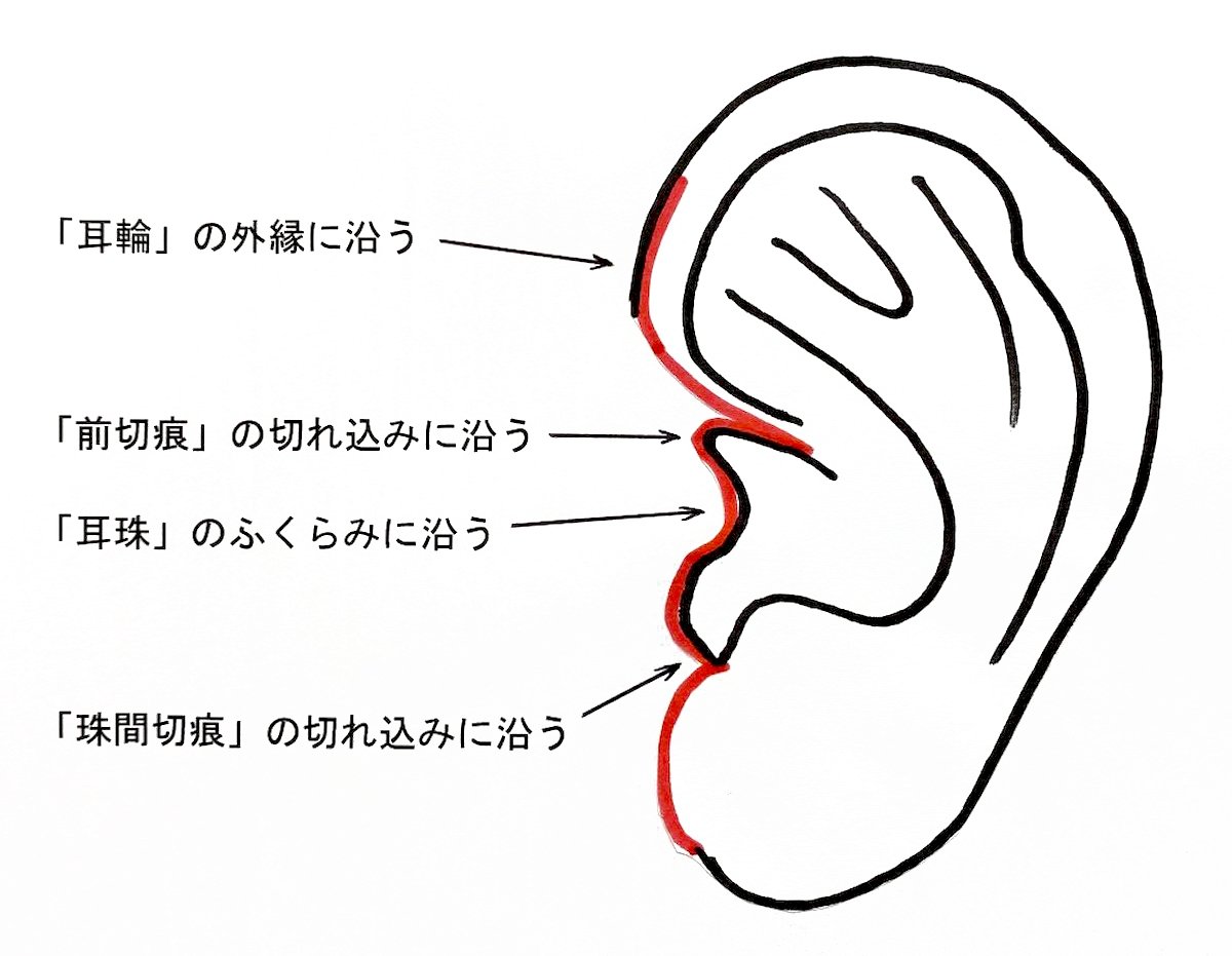 耳の複雑な形状を利用して輪郭やシワに沿って切ると傷跡が輪郭やシワと重なって目立たなくするテクニック