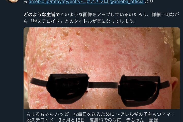 「脱ステロイド」はアトピーを悪化させる危険な言葉、近寄らないことが治療の王道。