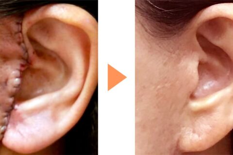 目立つ傷跡は残さない❗キレイに皮膚を縫うためのデザイン力