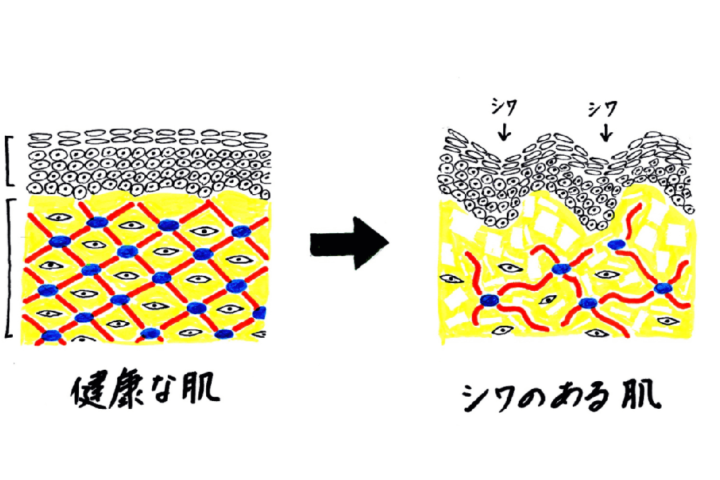 しわの原因・治療・予防の全て