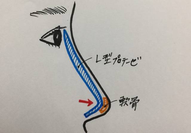 L型プロテーゼが鼻の中に埋め込まれている様子