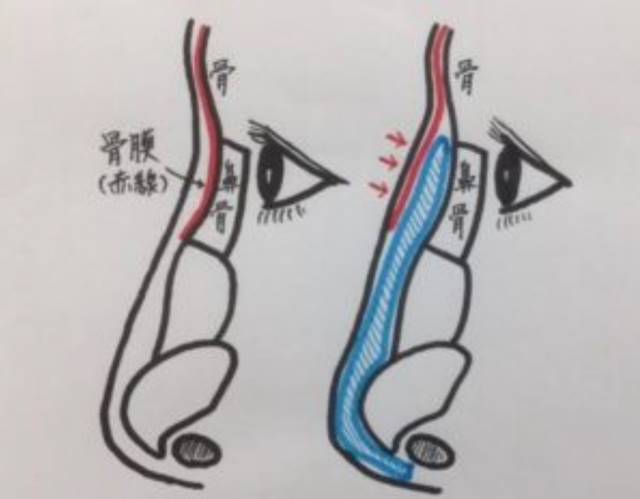 プロテーゼは鼻骨の骨膜に固定