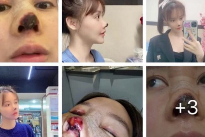 中国の女優が美容整形で失敗報道、原因を調べてみたら当然の結果かも。