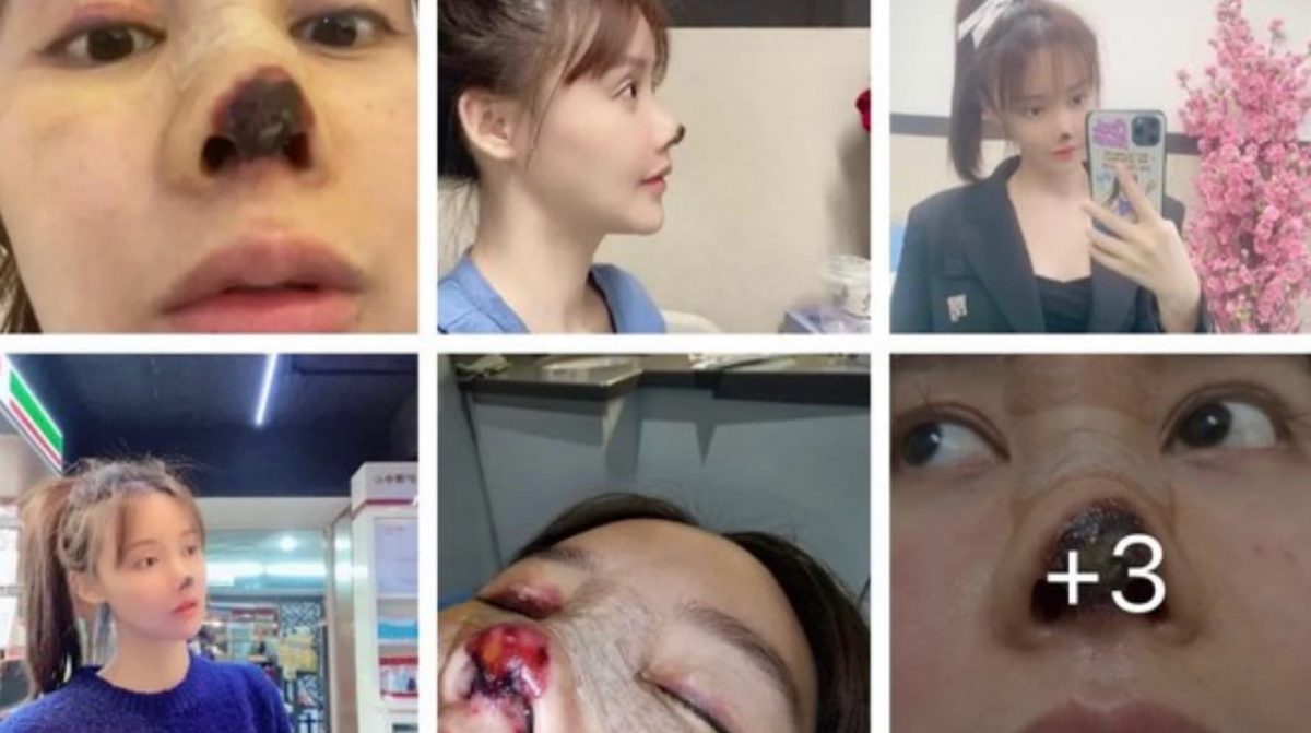 同種軟骨移植が原因 中国の女優が美容整形で失敗 との記事 何が原因でこんな悲惨な失敗 が起きたのか 現地メディアの情報をもとに説明します 院長ブログ 五本木クリニック 同種軟骨移植が原因 中国の女優が美容整形で失敗 との記事 何が原因でこんな悲惨な失敗 が起きたのか 現地メディアの情報をもとに説明します 院長ブログ 五本木クリニック