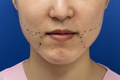 顔痩せの効果が最も高い脂肪吸引とはどんな施術か?