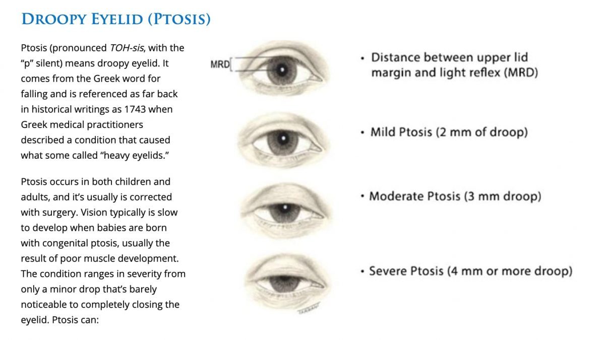 眼瞼下垂の手術は眼科 形成外科 それとも美容外科 院長ブログ 五本木クリニック