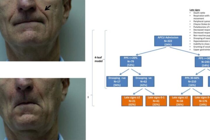 ほうれい線は死の予兆？死の3日前に、ほうれい線が浅くなる、との一流医学論文を読み解く