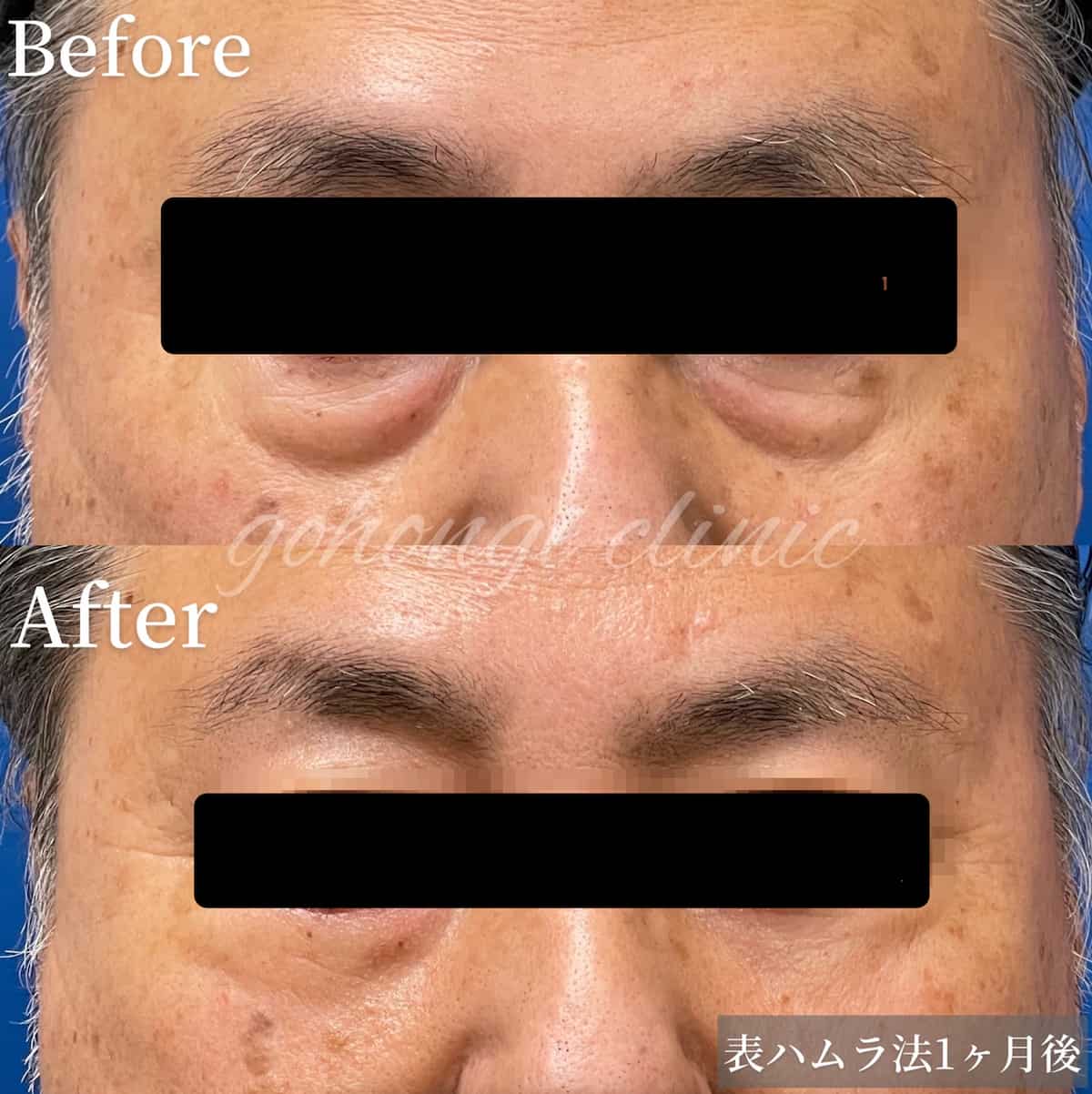中川剛医師の表ハムラ症例写真