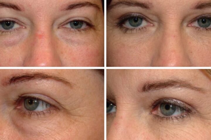 目の下のたるみを改善する美容外科手術「ハムラ法」って何？